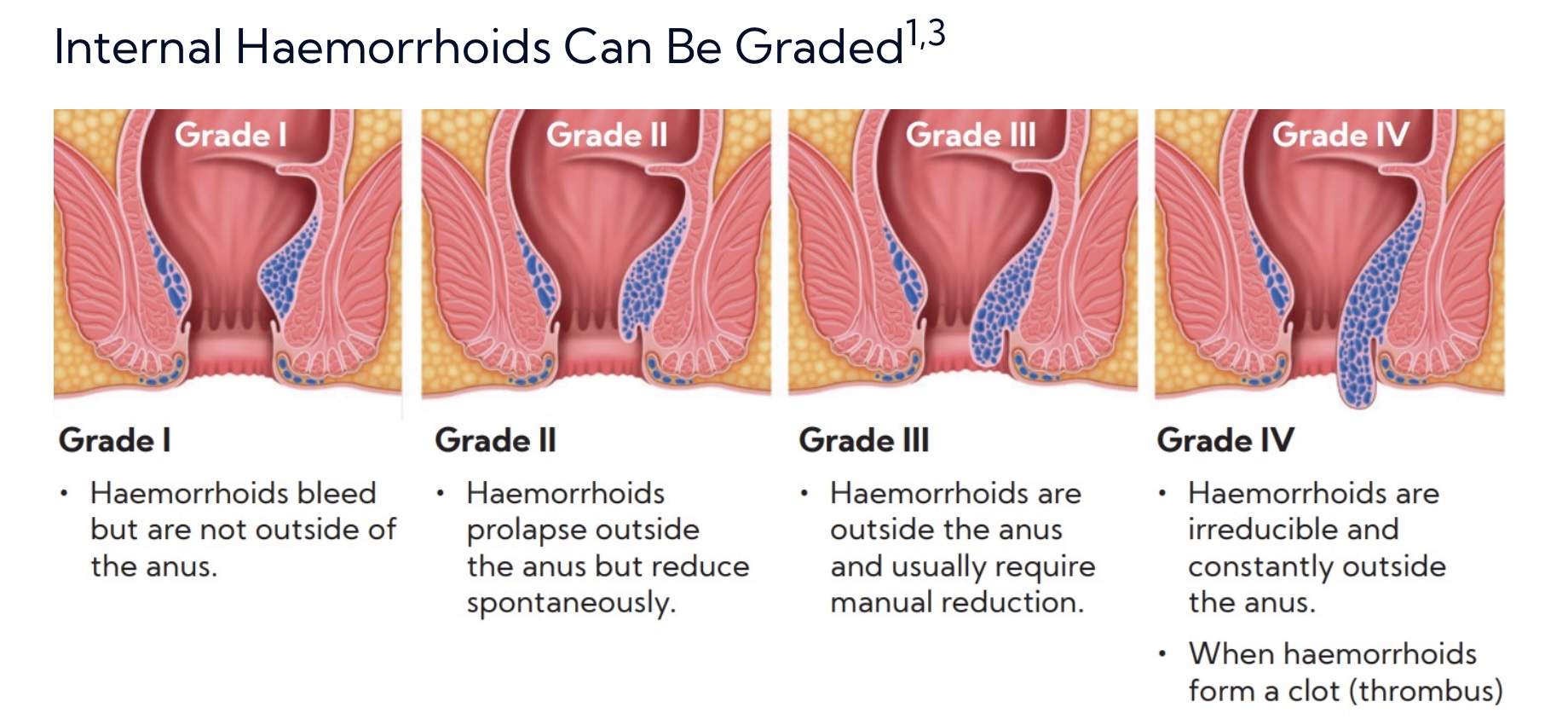 Haemorrhoids
